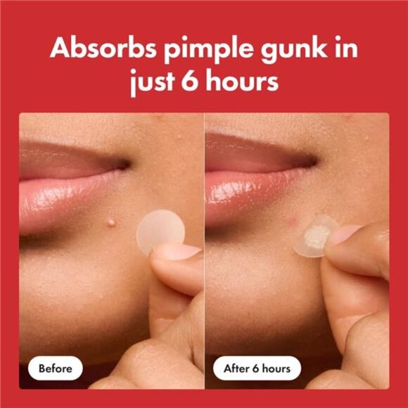 Mighty Patch™ Original patch from Hero Cosmetics – The #1 Hydrocolloid Acne - Picture 5 of 7